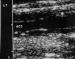 Abb. 16: Duplexsonographie - Intima-Media