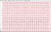 Aktuelles Bild - Abb. 1: EKG