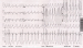 Abb. 2: EKG