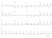 Abb. 1: EKG