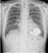 Abb. 1: Thoraxröntgen
