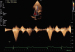 Aktuelles Bild - Abb. 2: Fall 1: LVOT-Gradient