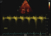 Abb. 4: Fall 2: LVOT-Gradient