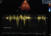 Abb. 6: Fall 3: LVOT-Gradient