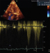 Abb. 7: Fall 3: LVOT-Gradient