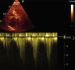 Abb. 9: Fall 4: LVOT-Gradient