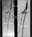 Abb. 6: Kissing-Stent