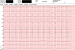 Abb. 2: EKG