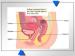 Abb. 2: Endometriose