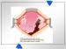 Abb. 3: Endometriose