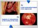Abb. 4: Endometriose