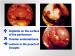Abb. 10: Endometriose