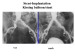 Abb. 13: Stent-Implantation