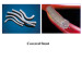 Abb. 19: Covered Stent