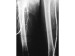 Abb. 24: Stenose/Verschluß-Typ