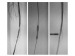 Abb. 33: Stentimplantation