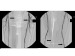 Abb. 37: Stentimplantation