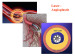 Abb. 66: Laser-Angioplastie