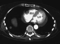 Abbildung 3: Metastasiertes Melanom - Kardiale Manifestation