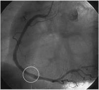 Abbildung 3: Mobiler Thrombus in der RCA bei NSTEMI