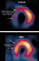 Abbildung 3: ST-Hebung nach Thalliumszintigraphie