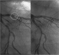 Abbildung 4: ST-Hebung nach Thalliumszintigraphie