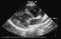 Abbildung 1: Kongenital korrigierte Transposition der großen Gefäße (ccTGA)