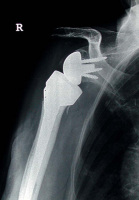 Abbildung 3: Prothese