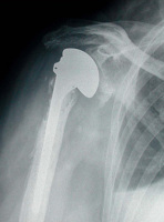 Abbildung 4: Prothese