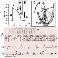Abbildung 10: Funktioneller Schenkelblock