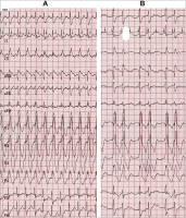 Abbildung 12: RSB-Aberration