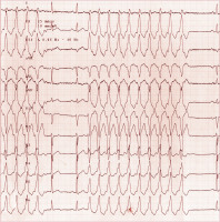 Abbildung 18: Ausflusstrakt-Tachykardie