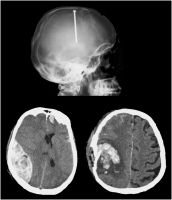 Abbildung 1: Nagelschussverletzung