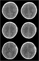 Abbildung 4: Epiduralhämatom