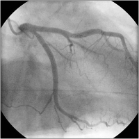 Abbildung 5: Transmurale Ischämie - Erstickungs-T-Wellen