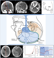 Abbildung 1: Hemikraniektomie