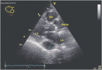 Abbildung 1: Sinus coronarius