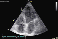 Abbildung 2: Sinus coronarius