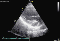 Abbildung 3: Sinus coronarius
