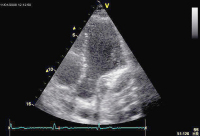 Abbildung 4: Sinus coronarius
