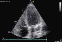 Abbildung 5: Sinus coronarius