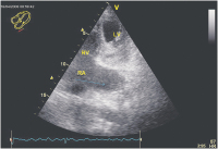 Abbildung 7: Sinus coronarius