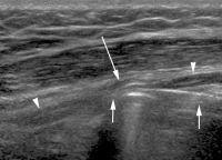 Abbildung 7: Nervus radialis