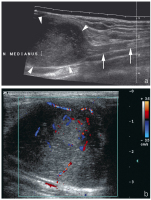Abbildung 9a-b: Nervus medianus