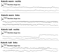 Abbildung 11: Elektronystagmogramm