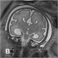 Abbildung 2-b: Fetus - 30. SSW