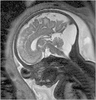 Abbildung 3: Fetus  - 33. SSW