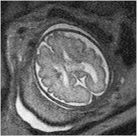 Abbildung 5: Fetus - 30. SSW