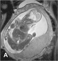 Abbildung 6-a: Plazenta  - 26. SSW