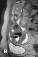 Abbildung 6-b: Plazenta  - 26. SSW